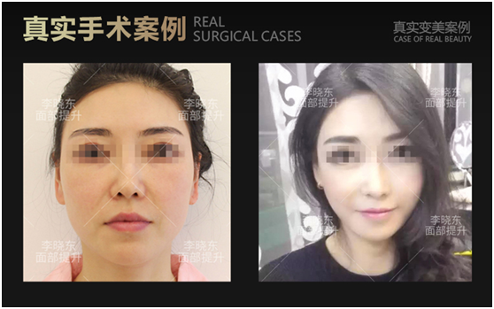 李曉東和楊博哪個面部提升更好？