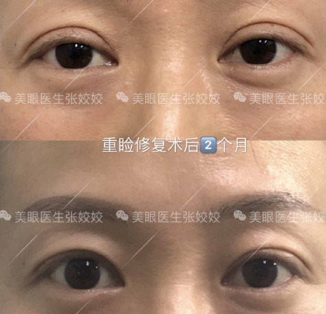 長沙雙眼皮修復哪個醫院比較好？