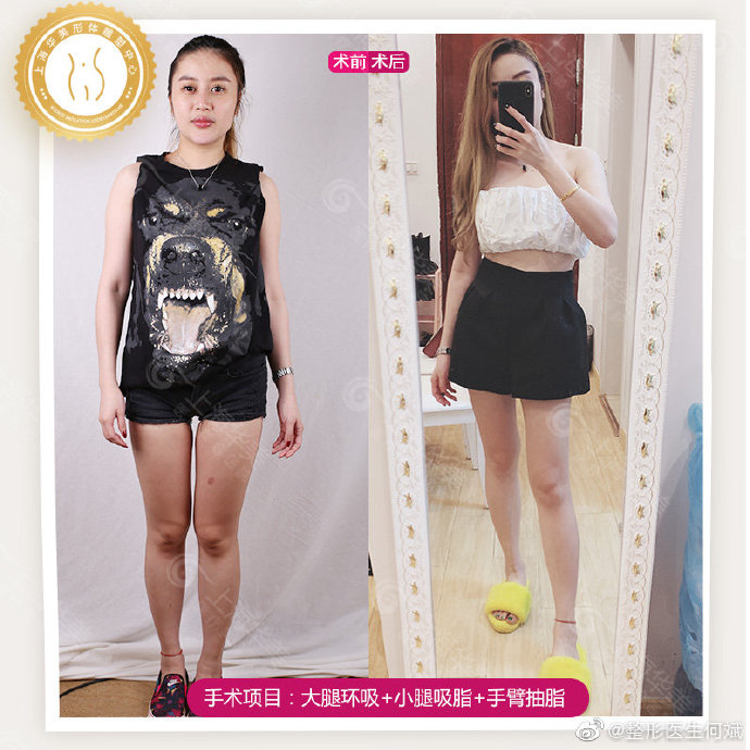 上海吸脂最厲害的醫(yī)院，上海大腿吸脂多少錢？