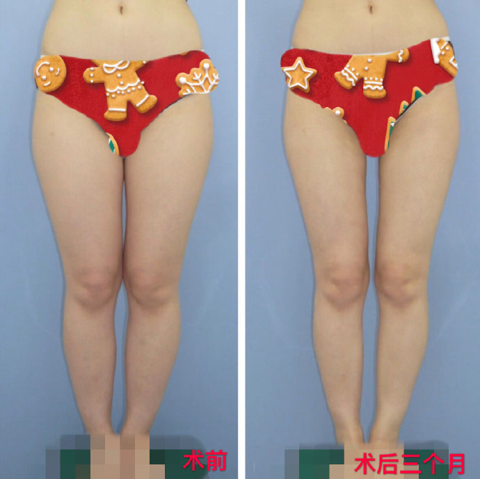 北京八大處大腿吸脂醫(yī)生哪個(gè)好？北京八大處大腿吸脂醫(yī)生排行榜