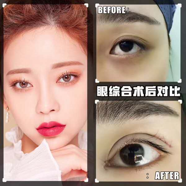杭州雙眼皮醫生哪個好？杭州雙眼皮醫生推薦