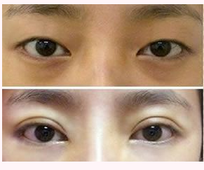 福州雙眼皮做得最好的醫生是誰？