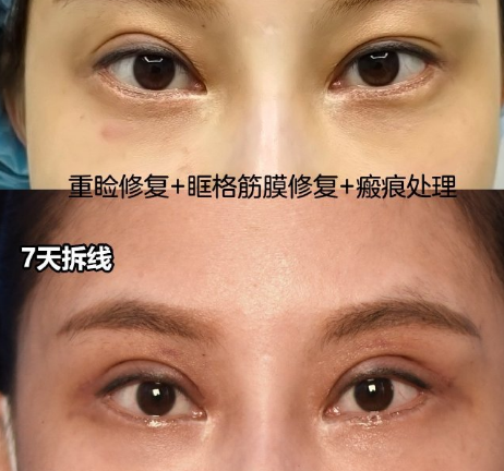 重慶劉曉偉做眼修復怎么樣