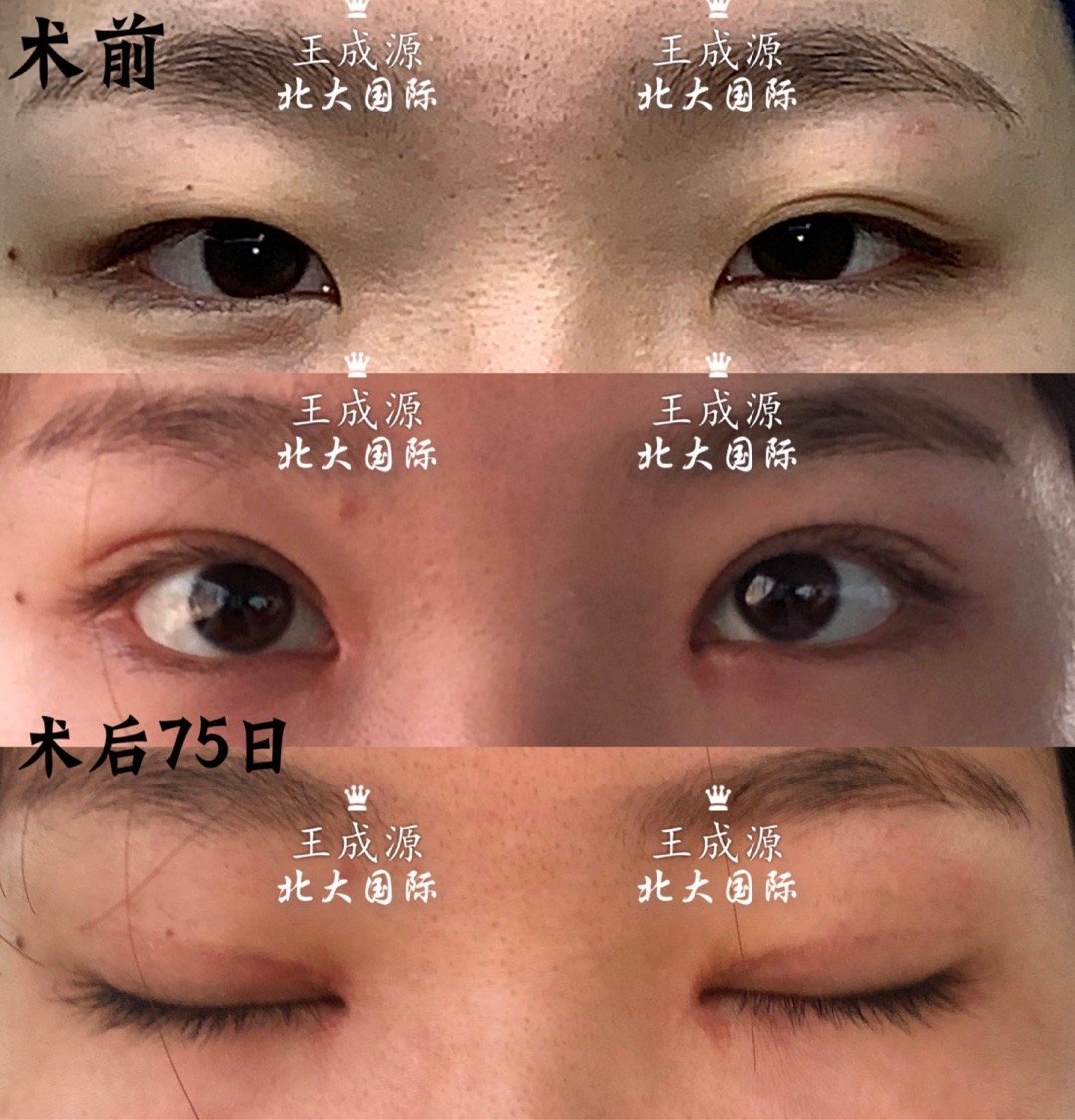 王成源雙眼皮案例