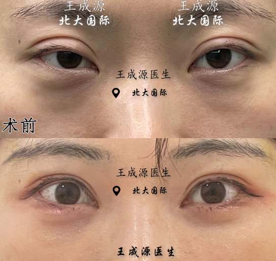 王成源雙眼皮修復案例