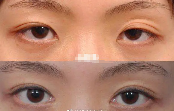 朱邦中修復(fù)雙眼皮案例