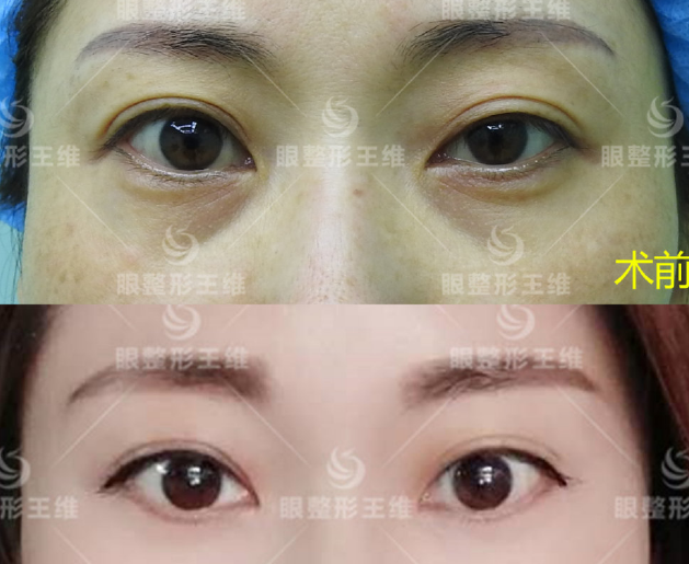 王維雙眼皮修復案例