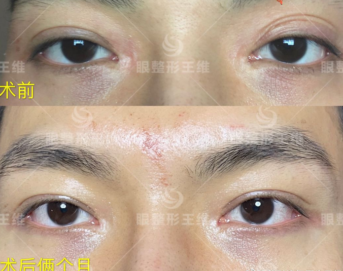 北京韓勛和王維誰修復(fù)雙眼皮厲害