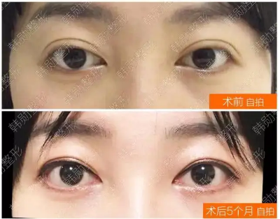 韓勛雙眼皮修復案例