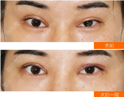 北京雙眼皮修復(fù)最牛的醫(yī)生是誰(shuí)