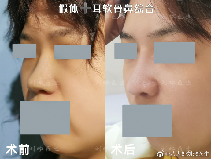 劉暾做鼻子案例