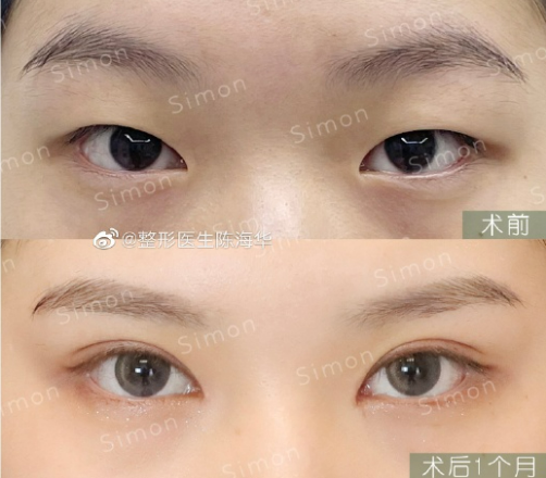 杭州陳海華做雙眼皮技術(shù)怎么樣？