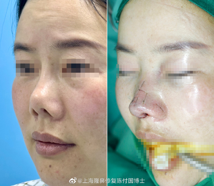 陳付國鼻修復(fù)案例