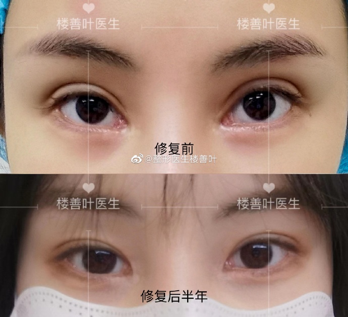 樓善葉和張冰潔誰修復(fù)內(nèi)眼角更厲害