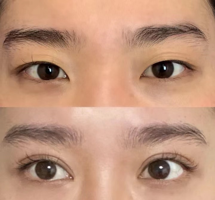 鄭州張丹陽做雙眼皮技術(shù)怎么樣