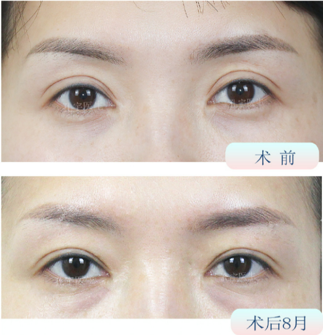 鄭州眼修復(fù)孔宇和楊麗誰技術(shù)更好