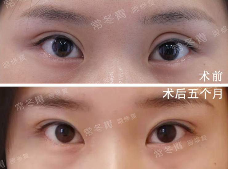 常冬青眼修復(fù)案例