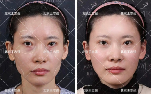北京脂肪填充哪個大夫最好?馮斌和王志強哪個好?
