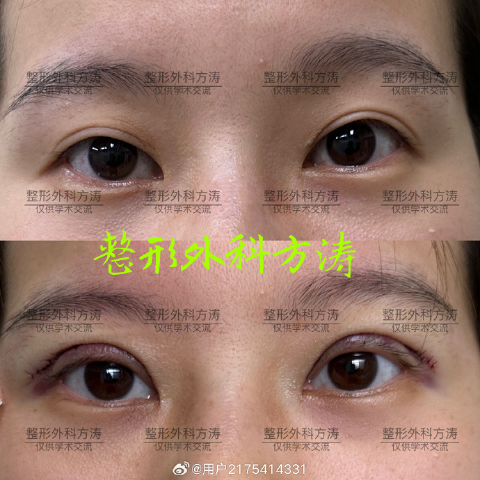 雙眼皮修復(fù)方濤和劉曉偉哪個醫(yī)生技術(shù)好？