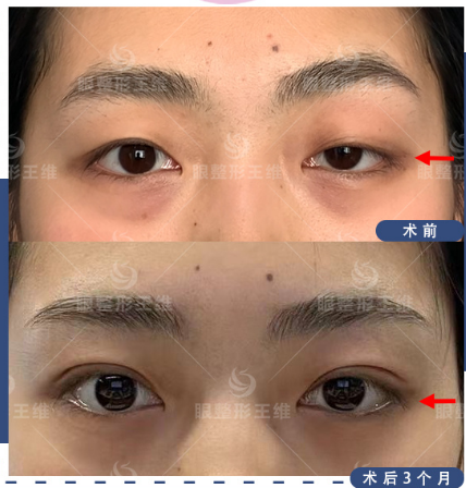 北京王維和常冬青哪個(gè)眼修復(fù)厲害