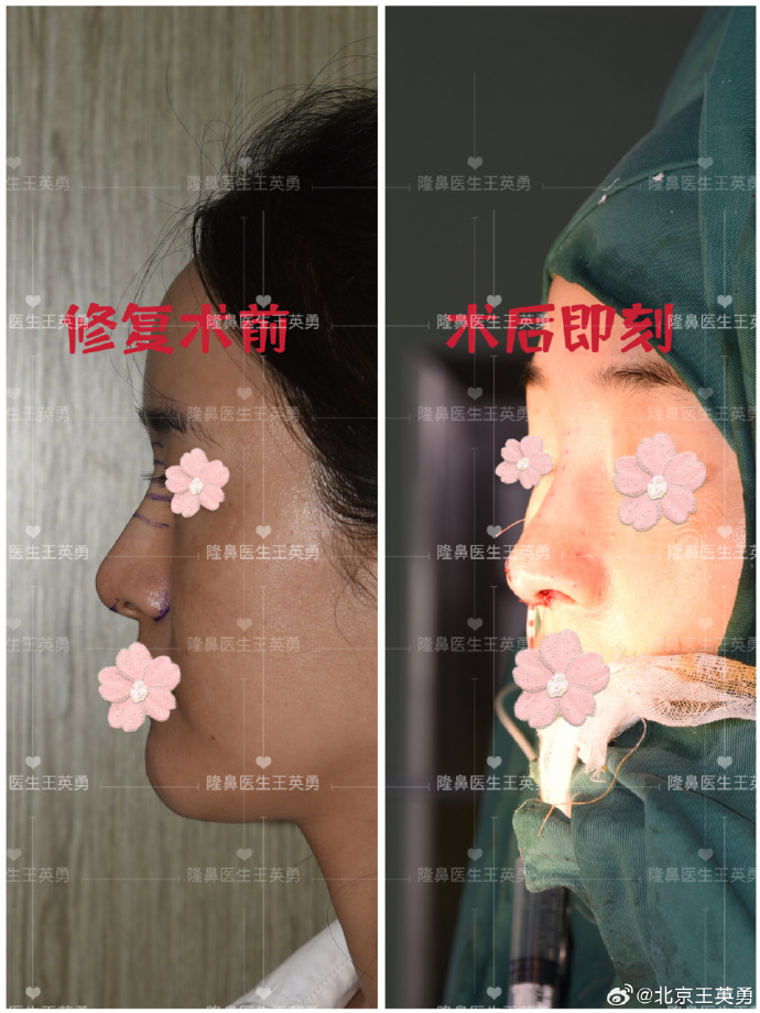 鼻修復王英勇和李長富哪個醫生好