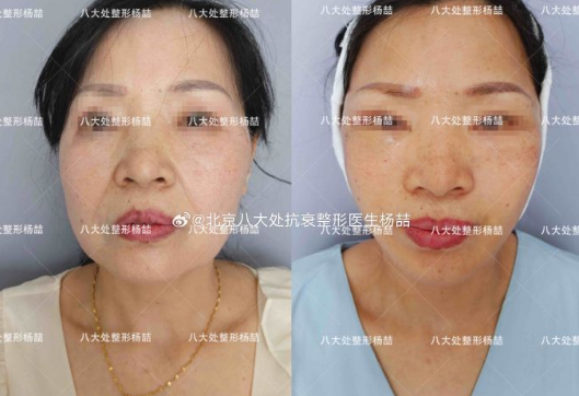 北京八大處拉皮醫生楊喆和趙延勇哪個好