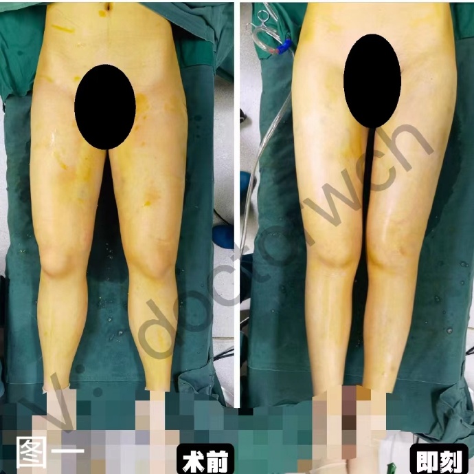 北京八大處吸脂哪個醫生好
