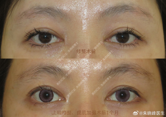 北京雙眼皮修復(fù)哪個(gè)醫(yī)生好