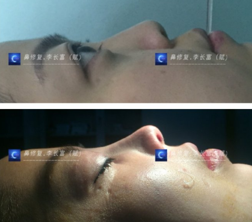 李長富鼻修復案例