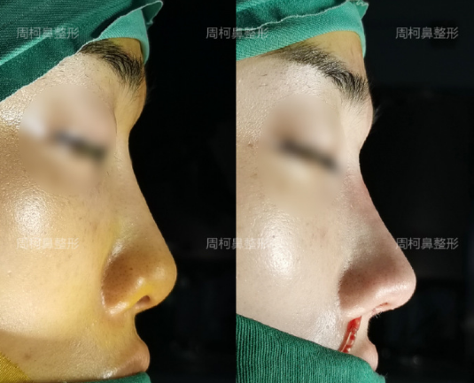 成都鼻修復哪個醫生技術好？周柯、倪云志、韓國棟？