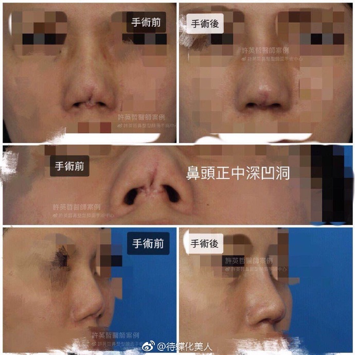 許英哲鼻修復案例