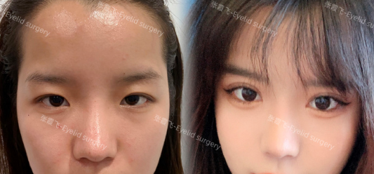 全國雙眼皮修復(fù)性價比高的醫(yī)生有哪些