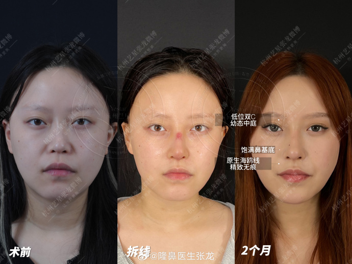 杭州鼻修復張龍和任東哪個好？