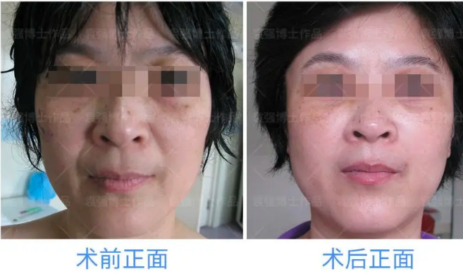 北京拉皮袁強(qiáng)和張海明哪個(gè)醫(yī)生好