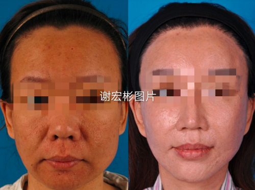 北京謝宏彬醫(yī)生大拉皮費(fèi)用是多少？