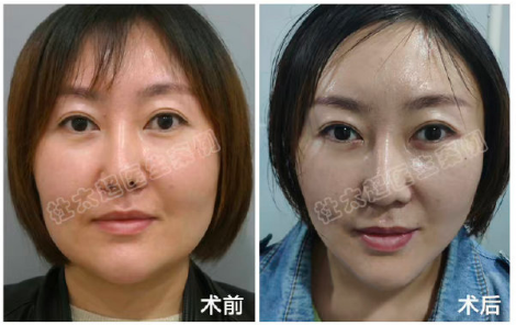 北京拉皮手術杜太超和黃寅守誰厲害