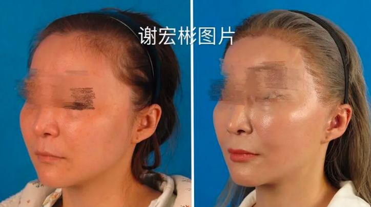 北京謝宏彬和謝洋春哪個拉皮技術好