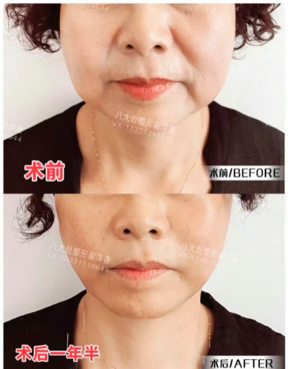 謝洋春拉皮案例