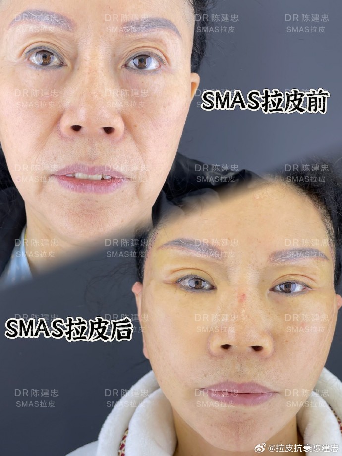 上海陳建忠醫生拉皮技術怎么樣