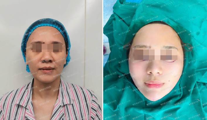 鄭州代禮先醫(yī)生面部提升技術怎么樣?