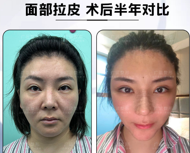鄭州魏廣運醫生做拉皮怎么樣？技術靠譜嗎？價格貴不貴？