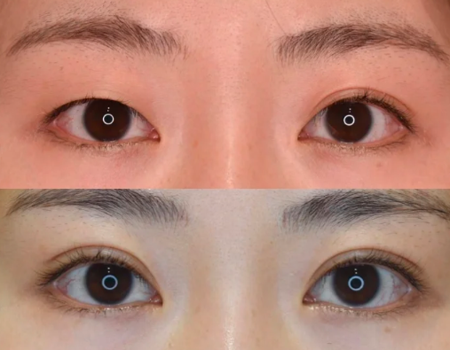 北京八大處做雙眼皮最好的醫生是誰