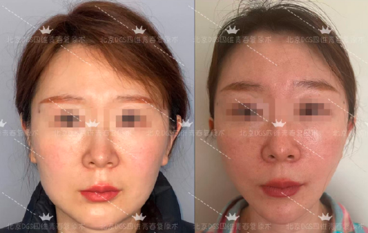 北京面部拉皮楊俊、杜太超、李曉東哪個醫生好？