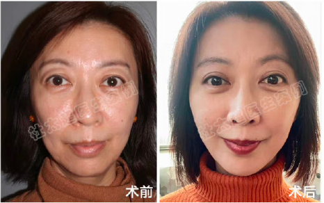 北京黃寺拉皮醫生杜太超和李曉東誰的技術好