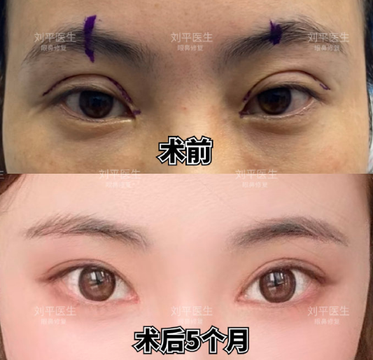 上海劉平修復(fù)雙眼皮怎么樣？技術(shù)好不好？