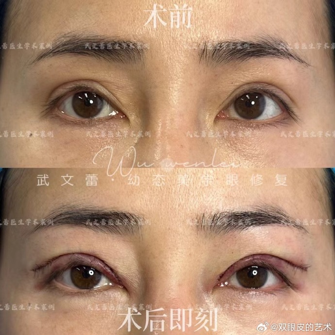 北京武文蕾修復(fù)雙眼皮怎么樣？