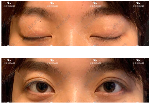 北京協和白明雙眼皮做的怎么樣？