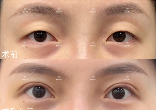 長沙張姣姣雙眼皮做得怎么樣