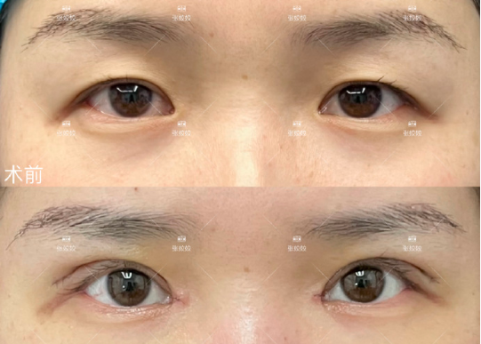 張姣姣雙眼皮案例