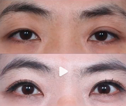 馬志兵雙眼皮案例